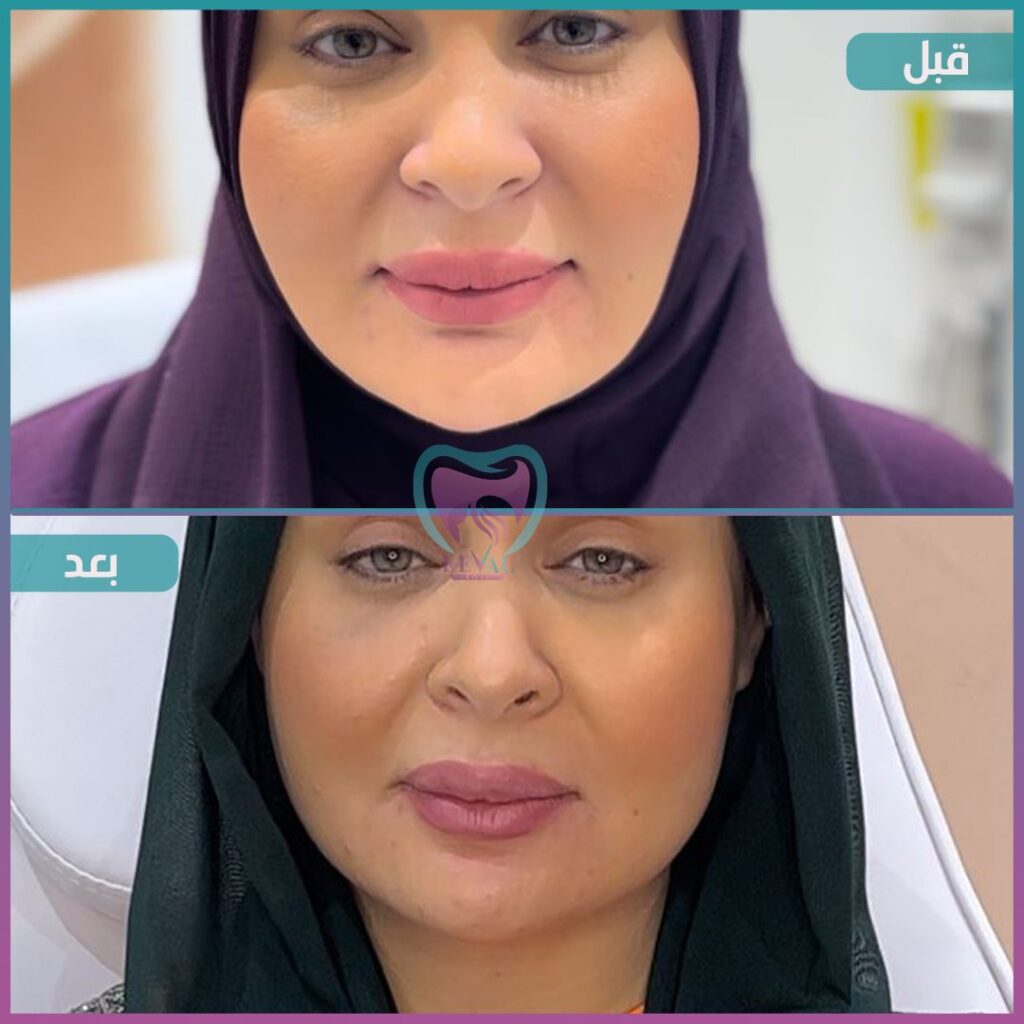 بوتكس Botox