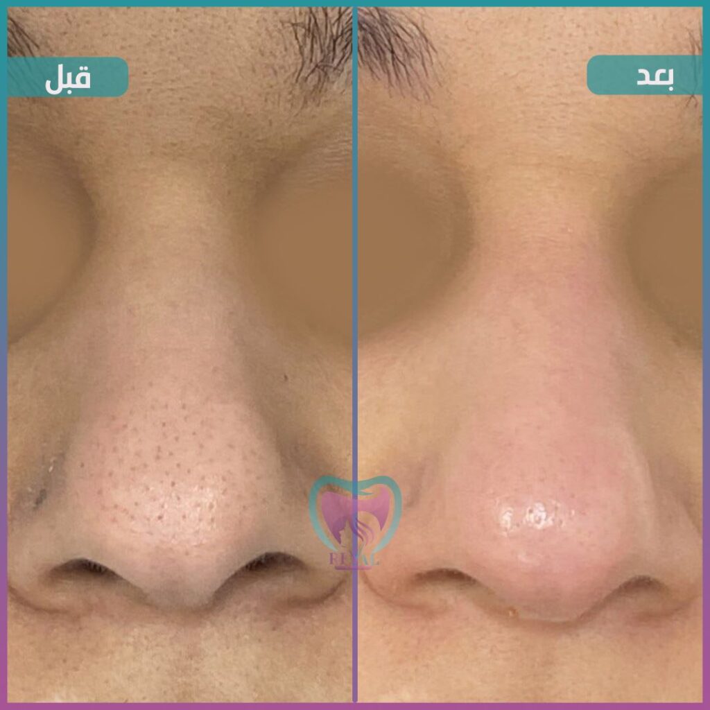 تنظيف بشرة Skin cleansing