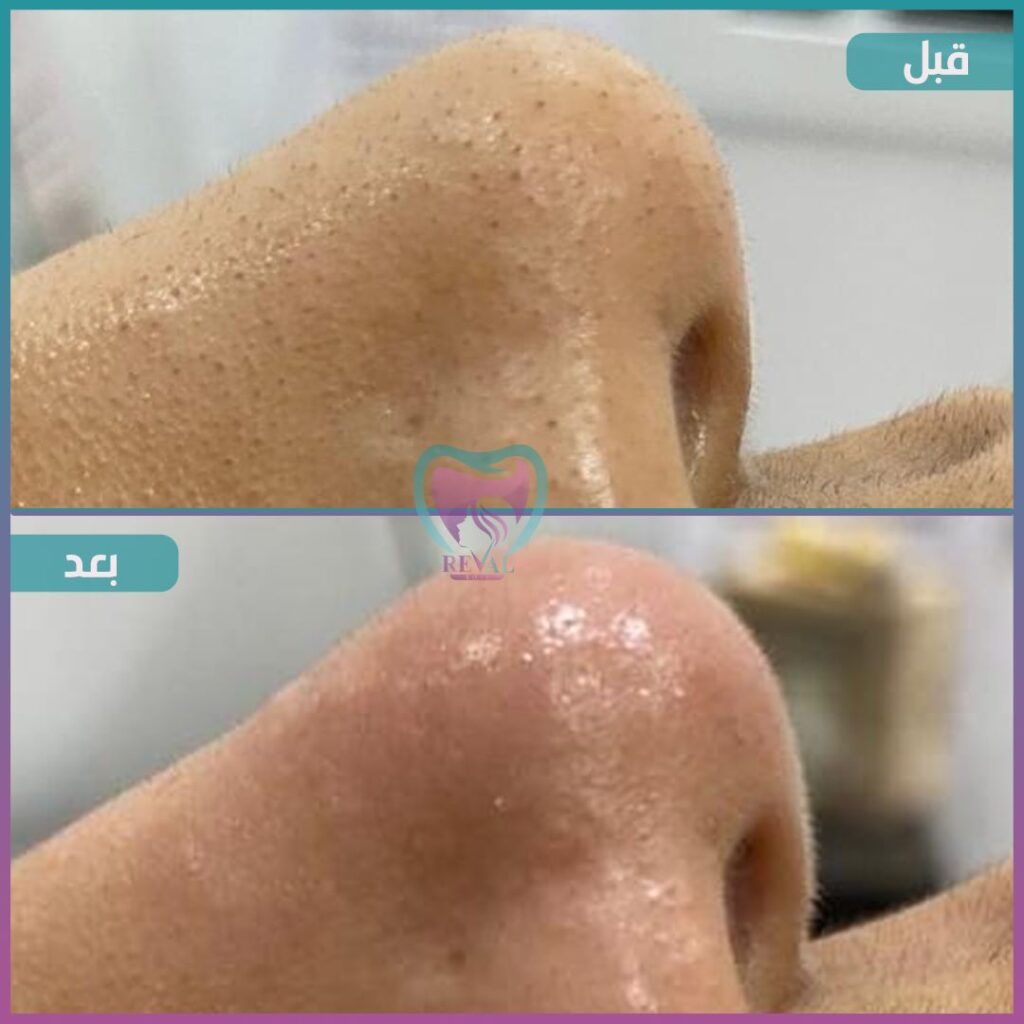 تنظيف بشرة Skin cleansing