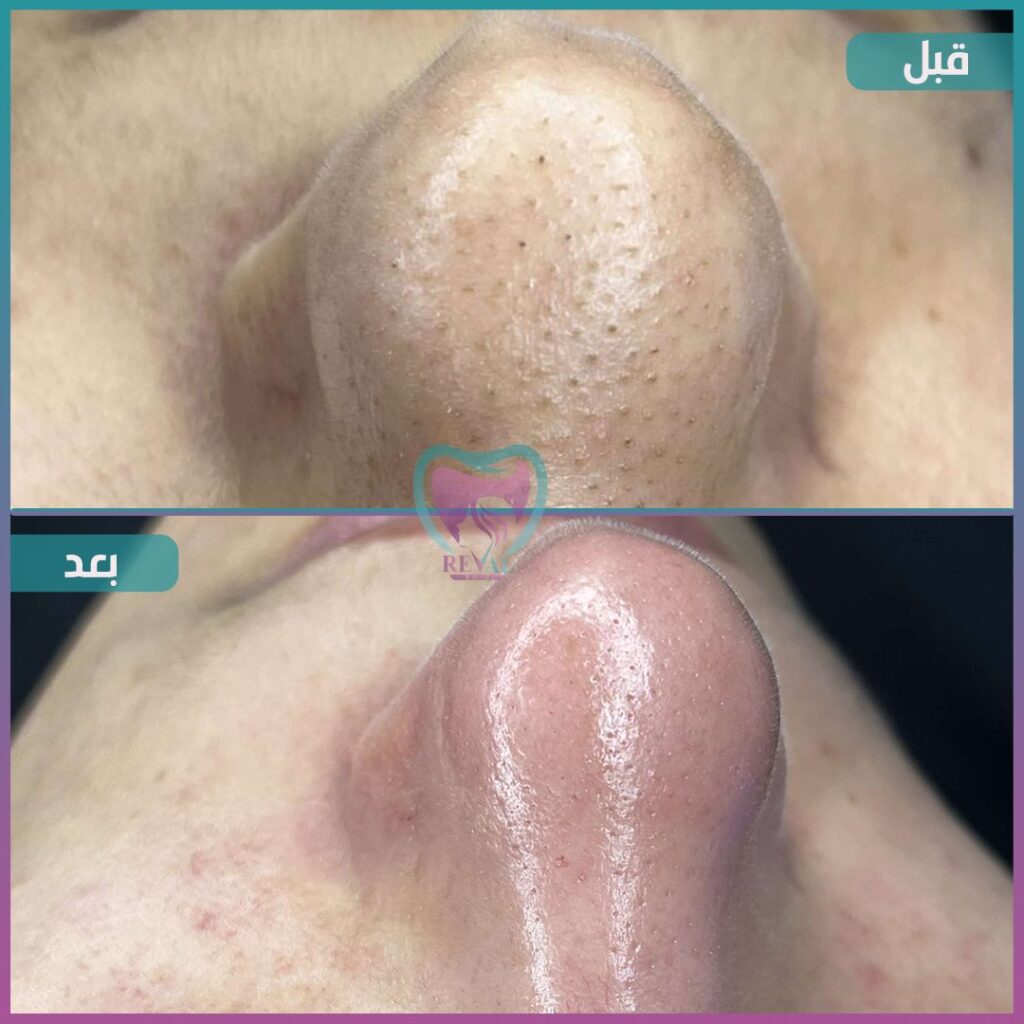 تنظيف بشرة Skin cleansing