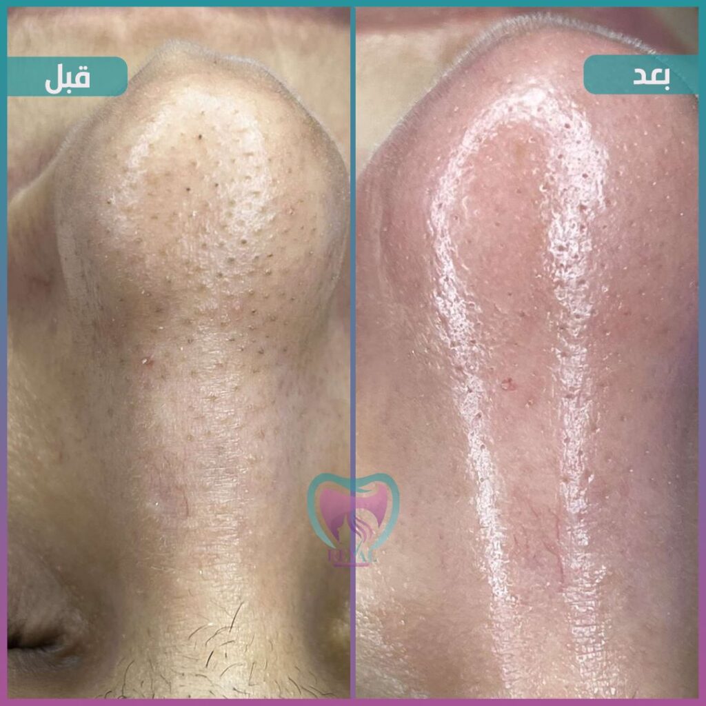 تنظيف بشرة Skin cleansing