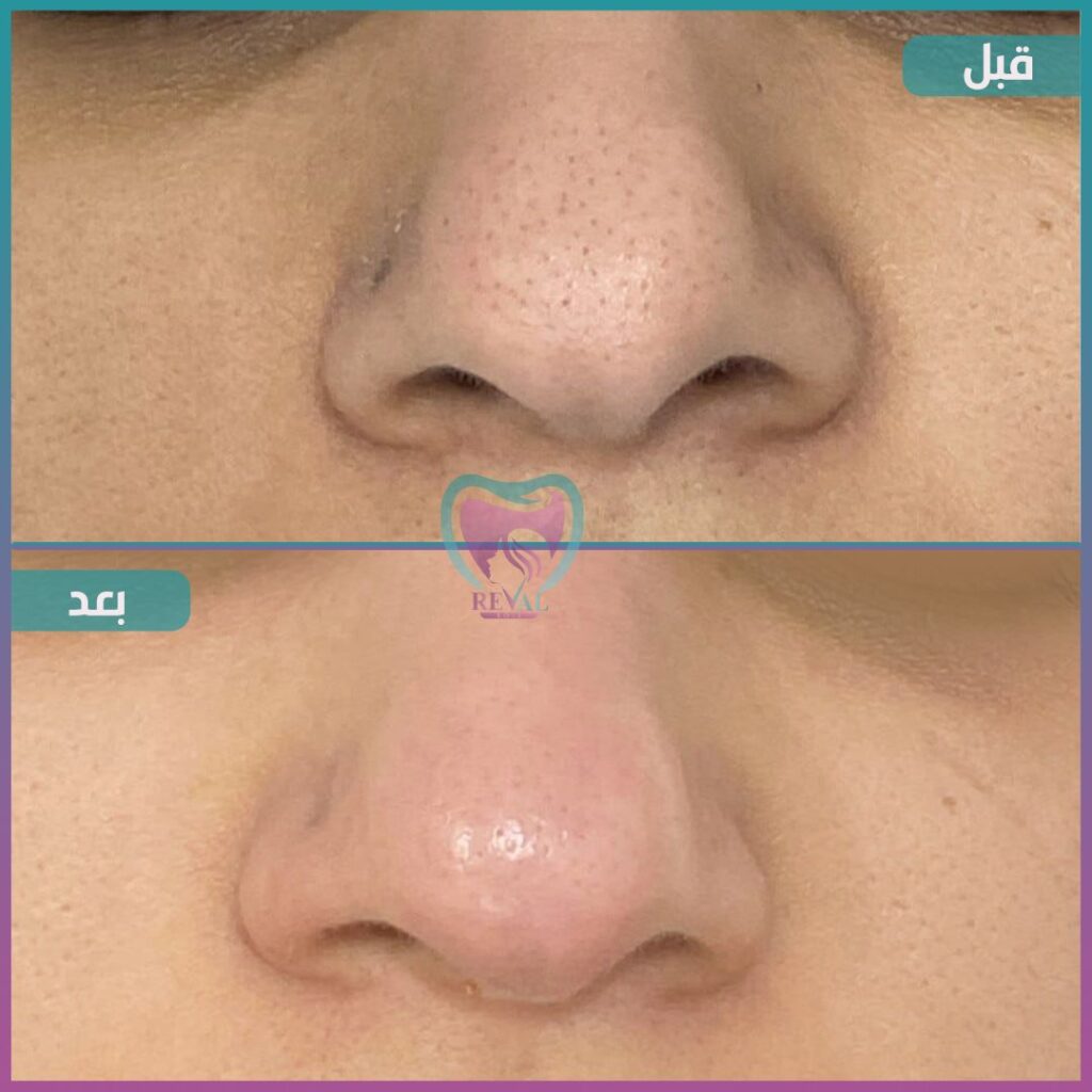 تنظيف بشرة Skin cleansing