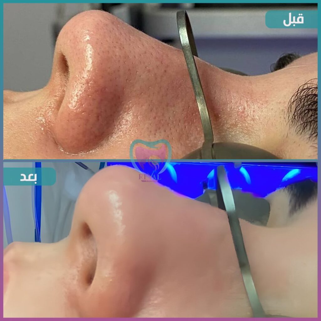 تنظيف بشرة Skin cleansing