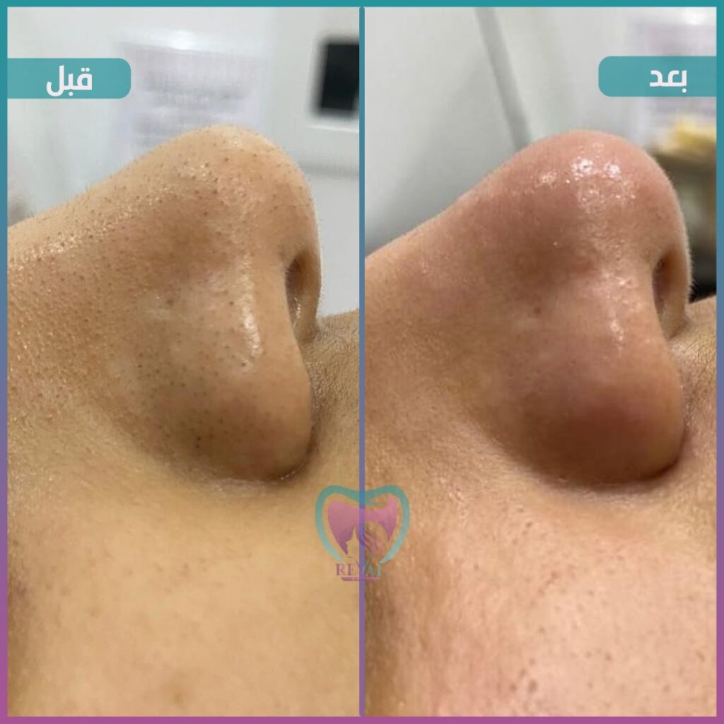 تنظيف بشرة Skin cleansing