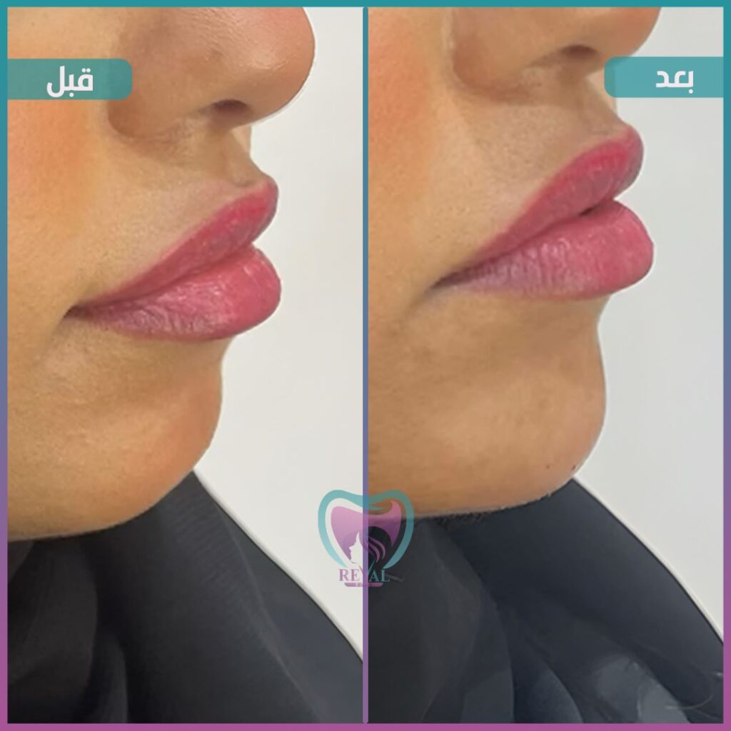 فيلر شفايف Lip filler