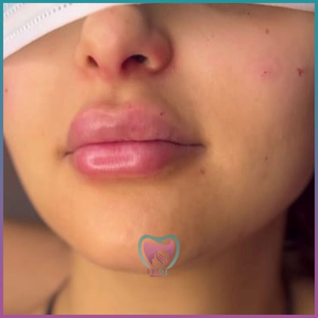 فيلر شفايف Lip filler