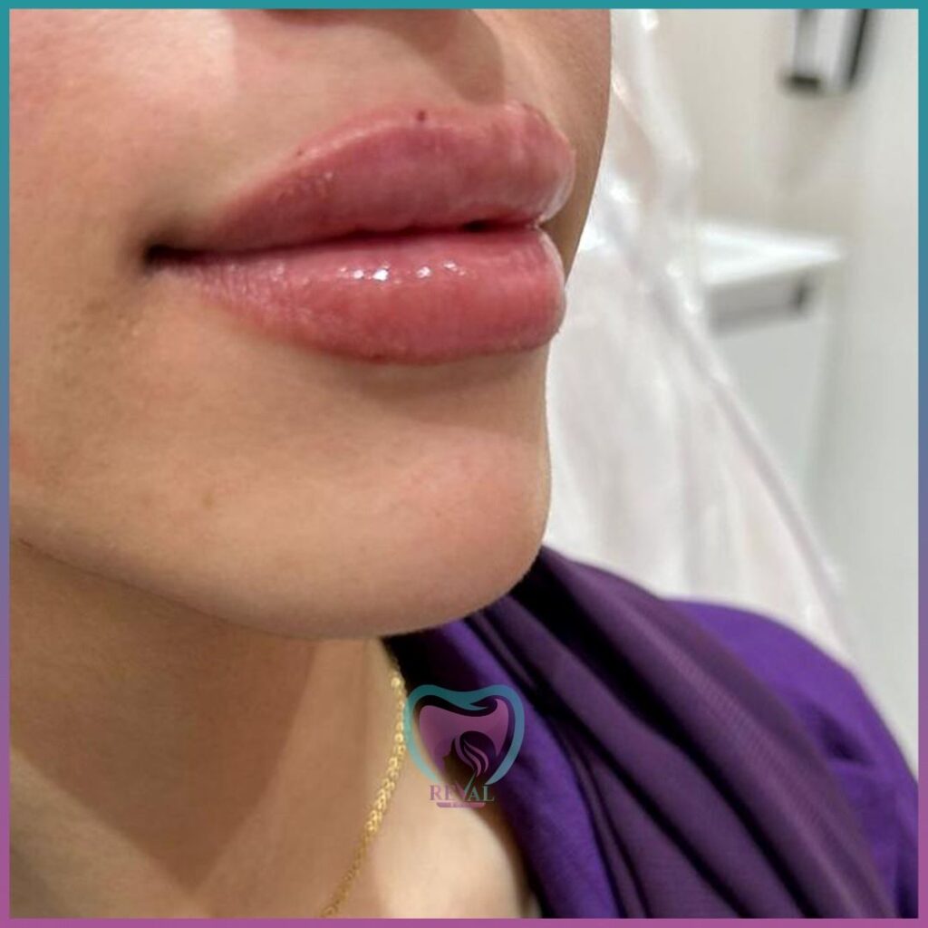 فيلر شفايف Lip filler