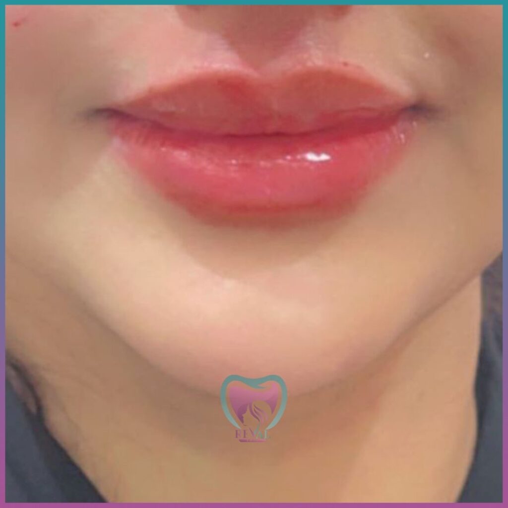 فيلر شفايف Lip filler