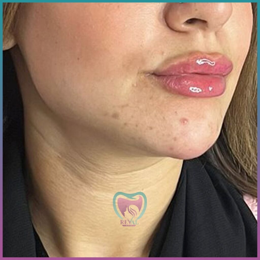 فيلر شفايف Lip filler