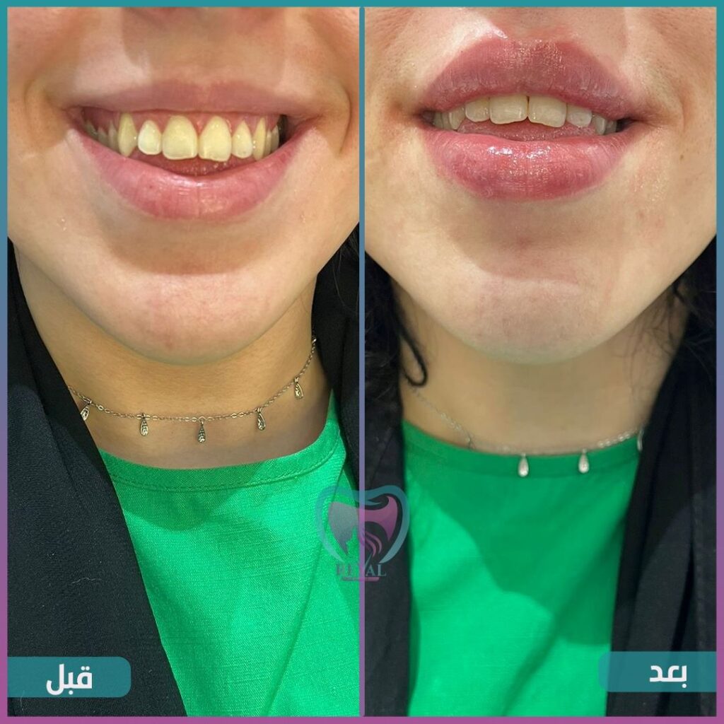 فيلر شفايف Lip filler