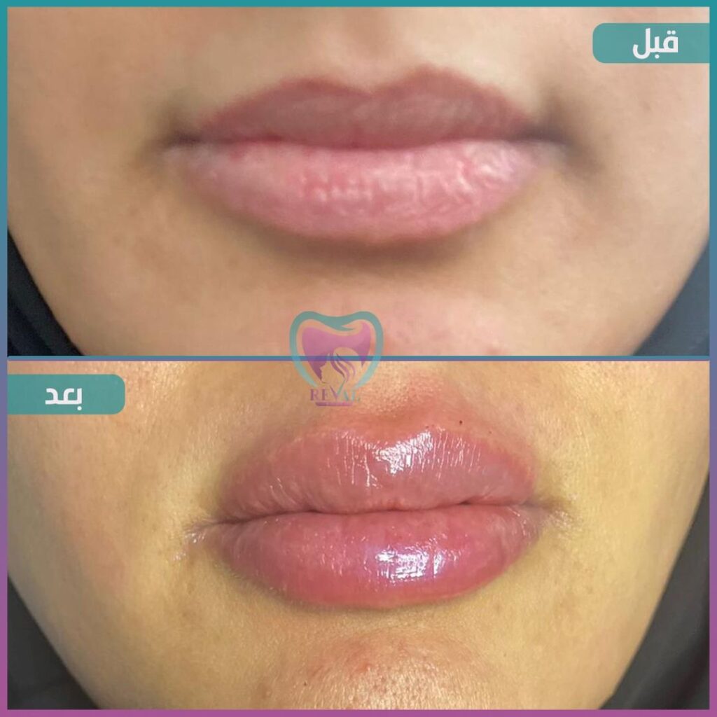 فيلر شفايف Lip filler