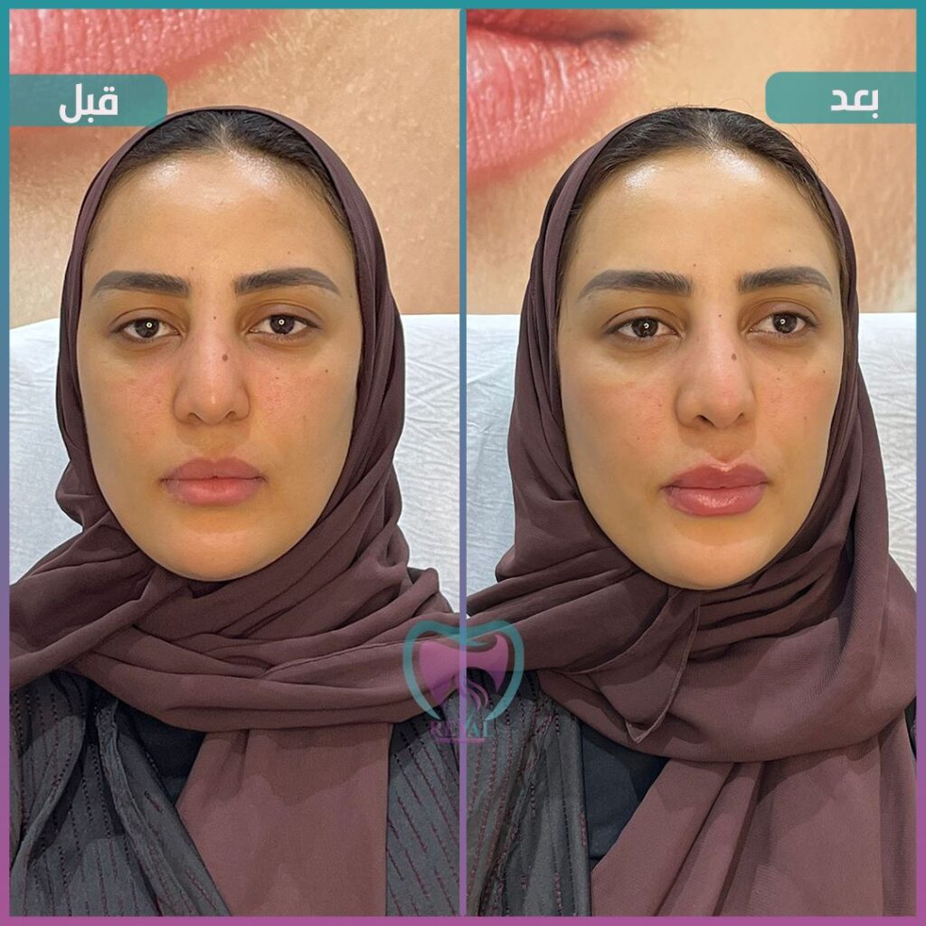 فيلر شفايف Lip filler