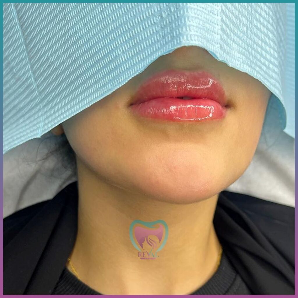 فيلر شفايف Lip filler