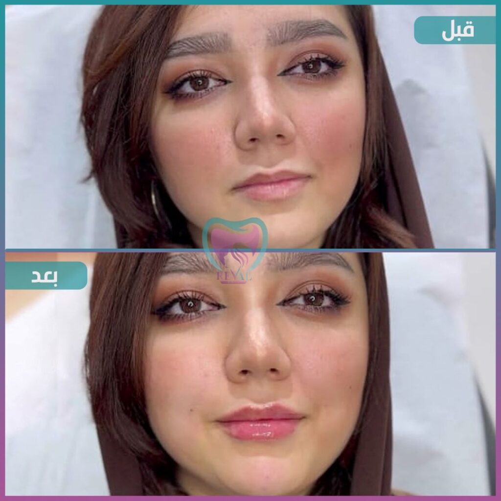 فيلر شفايف Lip filler