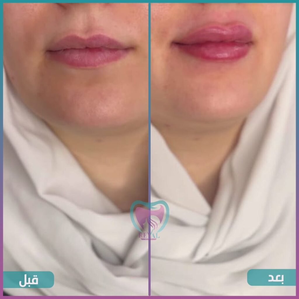 فيلر شفايف Lip filler