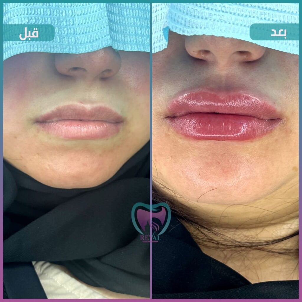 فيلر شفايف Lip filler