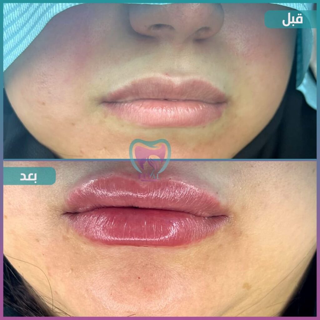 فيلر شفايف Lip filler