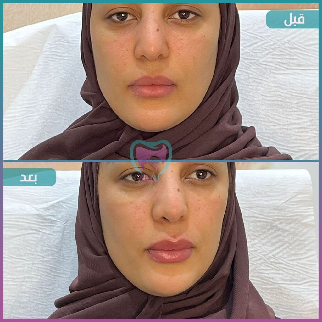 فيلر شفايف Lip filler