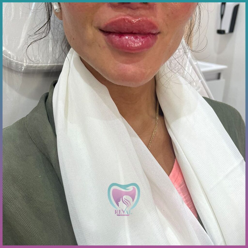 فيلر شفايف Lip filler