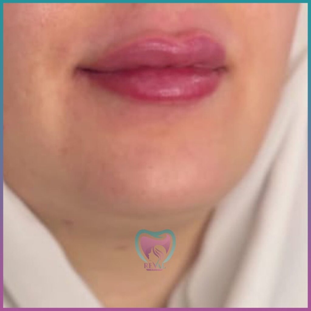 فيلر شفايف Lip filler