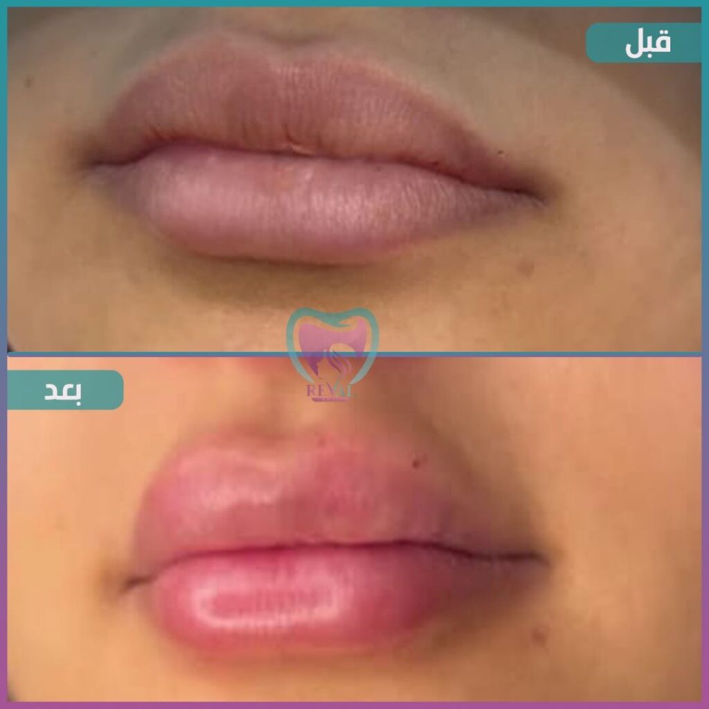 فيلر شفايف Lip filler