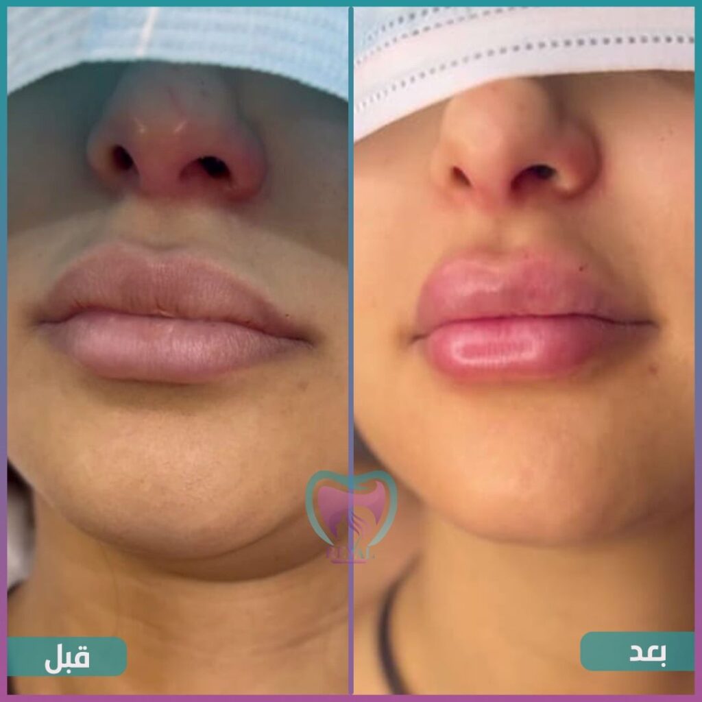 فيلر شفايف Lip filler