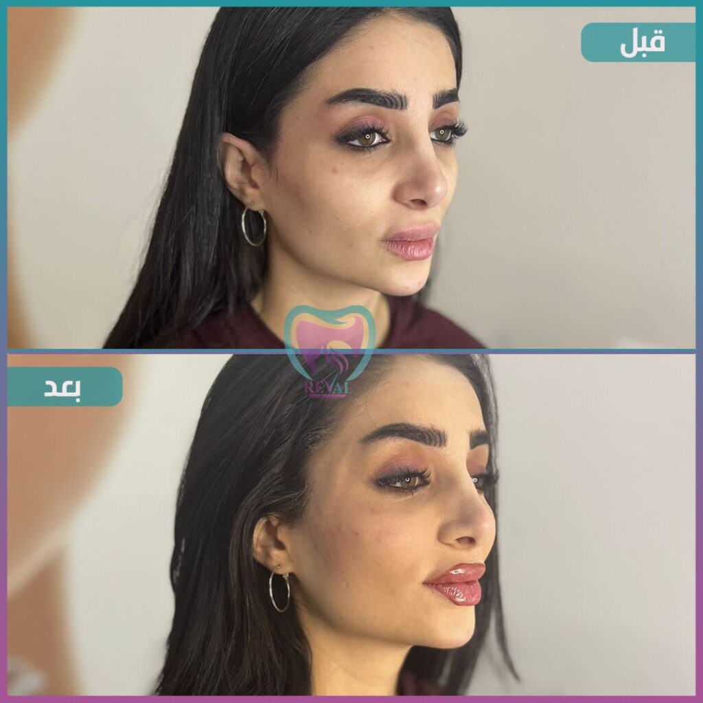 فيلر وجه كامل Full face filler