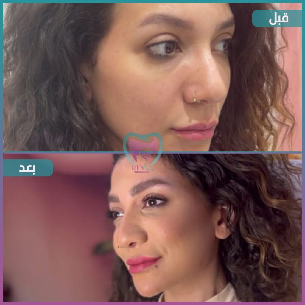 فيلر وجه كامل Full face filler