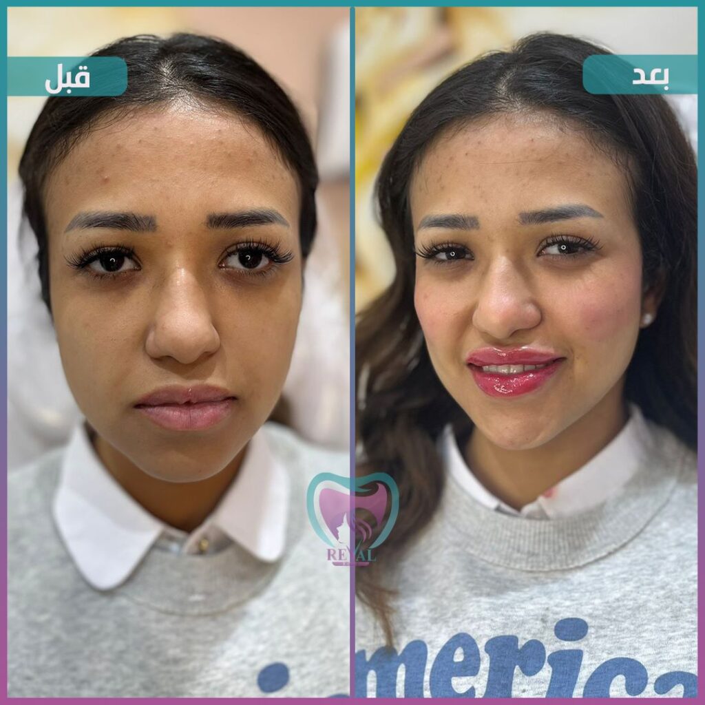 فيلر وجه كامل Full face filler