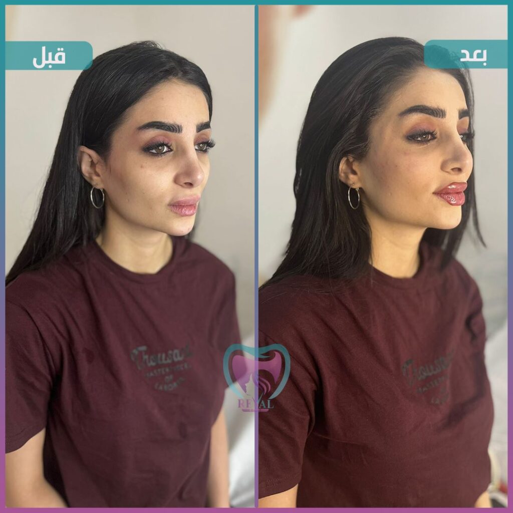 فيلر وجه كامل Full face filler