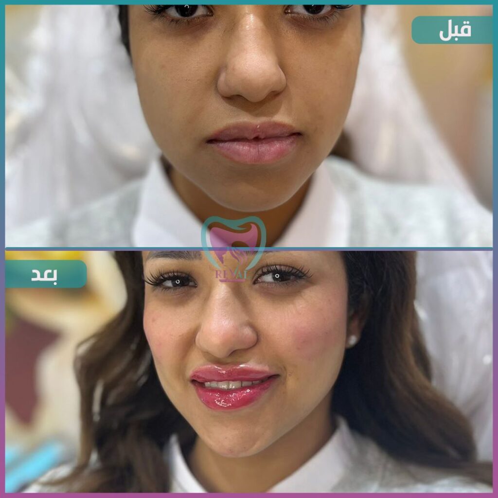 فيلر وجه كامل Full face filler