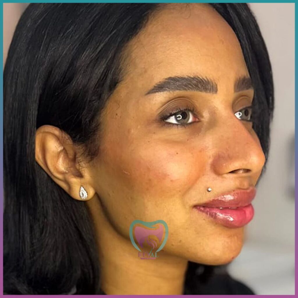 فيلر وجه كامل Full face filler