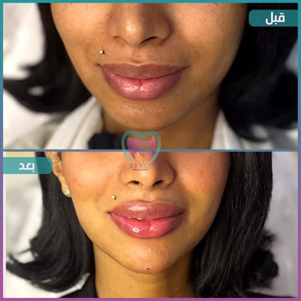 فيلر وجه كامل Full face filler