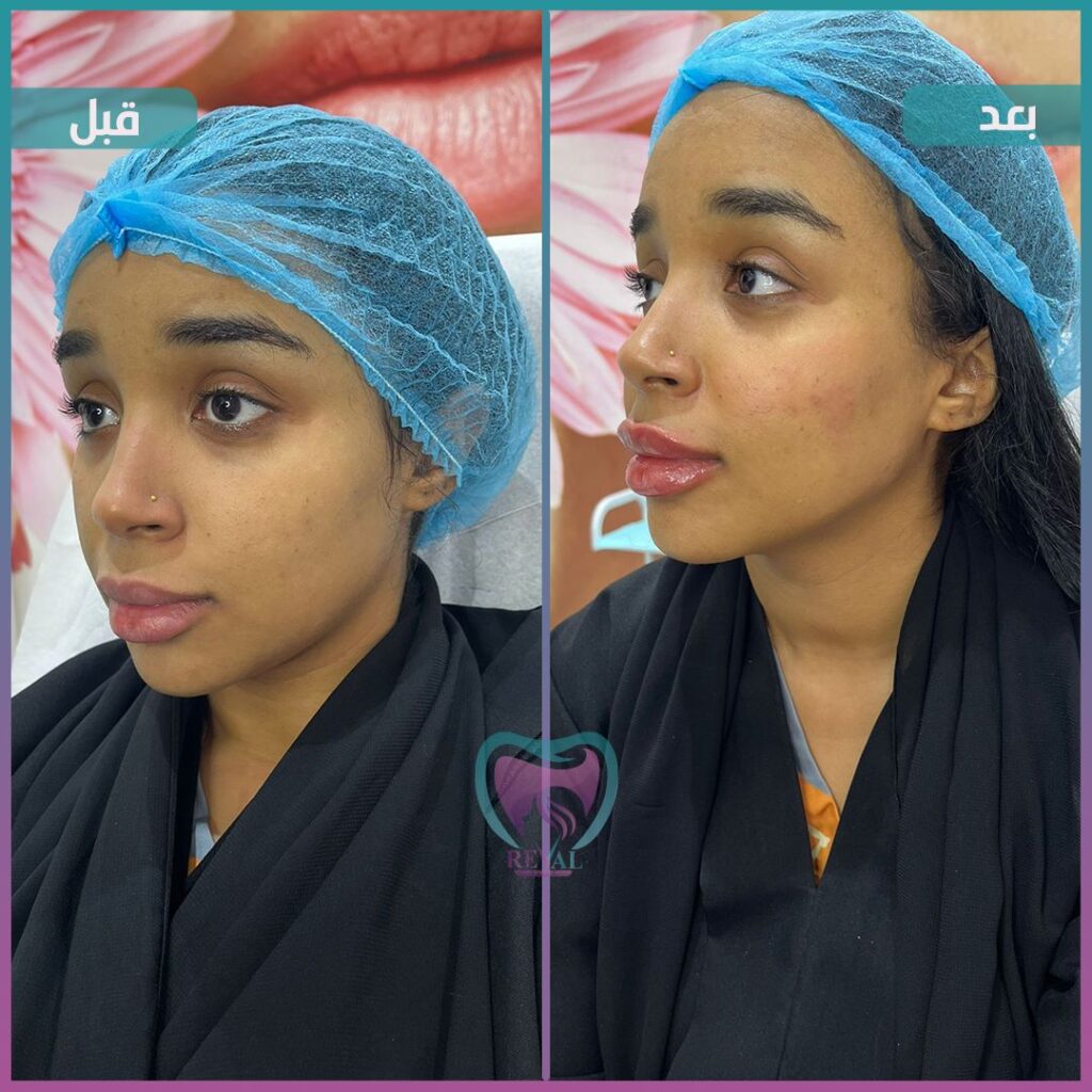 فيلر وجه كامل Full face filler