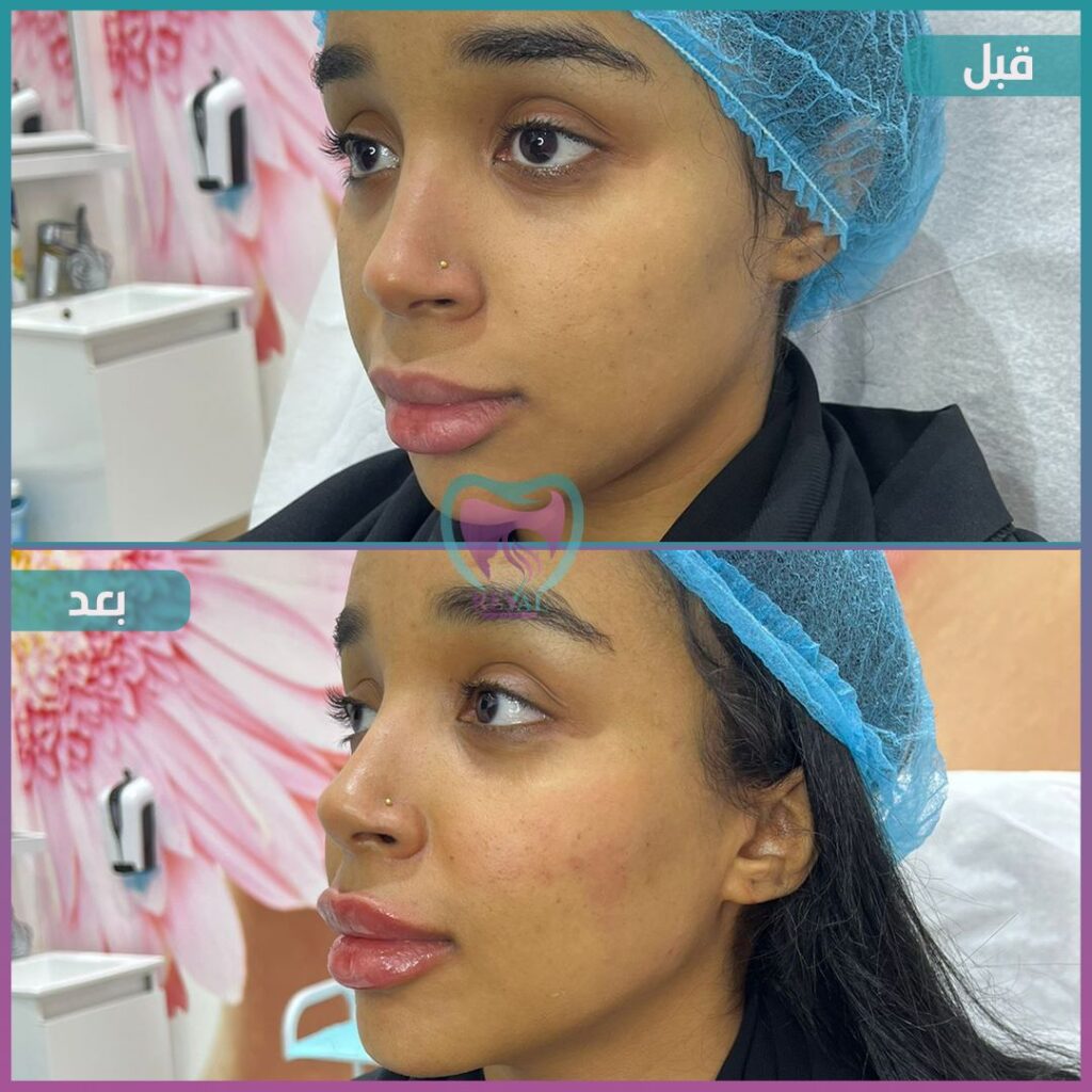 فيلر وجه كامل Full face filler