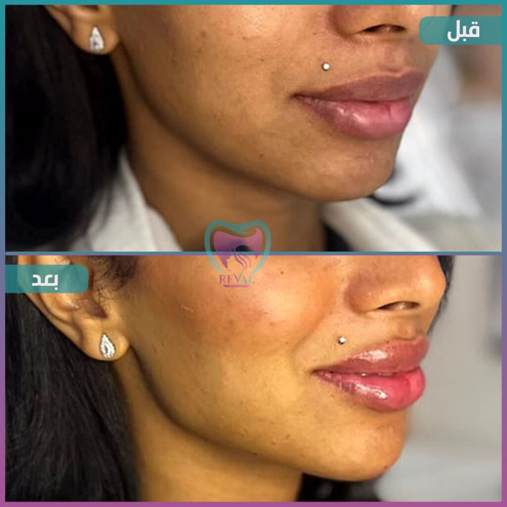 فيلر وجه كامل Full face filler