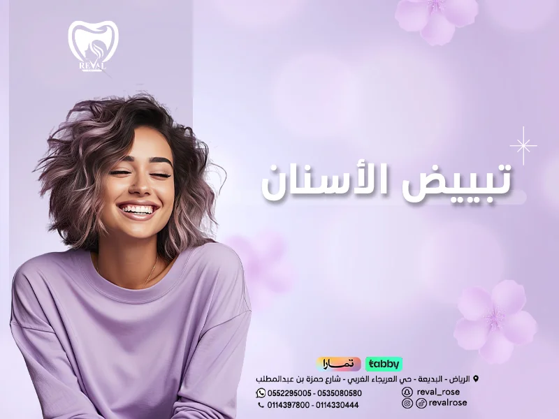 كم يدوم تبييض الاسنان بالليزر
