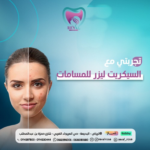 اسعار جلسات السيكريت ليزر للمسامات في الرياض