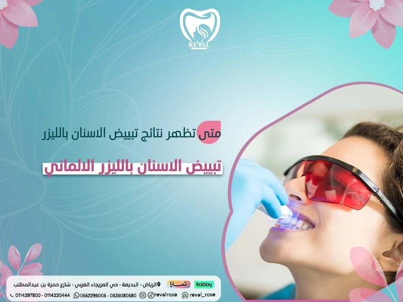 متى تظهر نتائج تبييض الأسنان بالليزر: كم تدوم نتائج التبييض؟