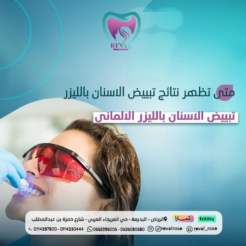 تجربتي مع تبييض الأسنان بالليزر