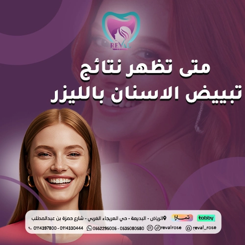 تبييض الأسنان بالليزر