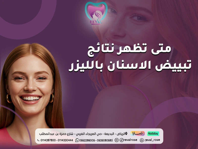 متى تظهر نتائج تبييض الأسنان بالليزر