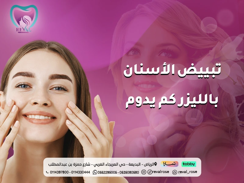 تبييض الأسنان بالليزر كم يدوم: كيف تستمر نتائج تلميع الاسنان فترة اطول؟
