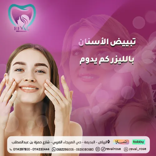 تجربتي مع تبييض الأسنان بالليزر