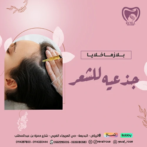 تجربتي مع بلازما خلايا جذعيه للشعر