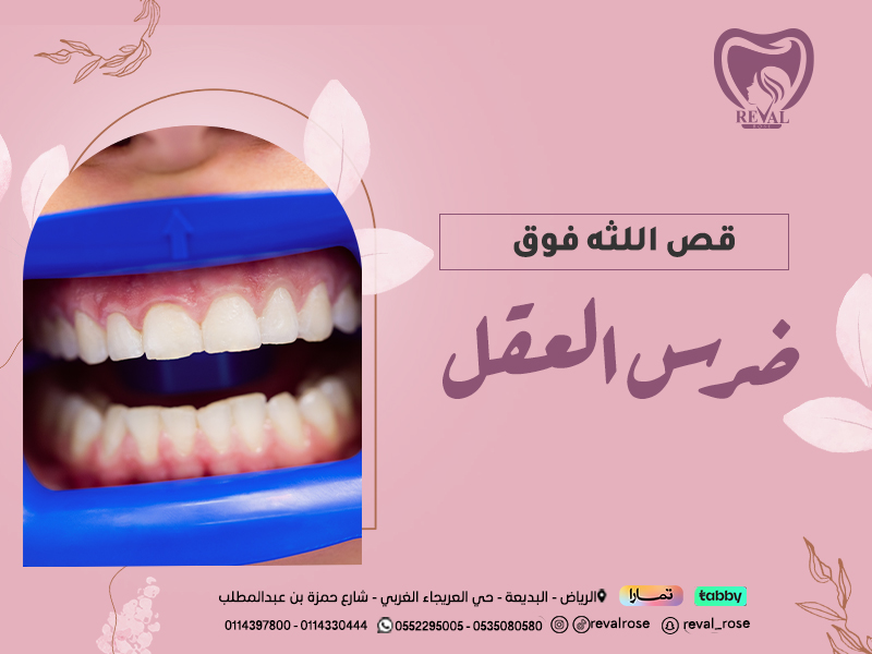 قص اللثة فوق ضرس العقل – الدليل الشامل للإجراء والفوائد والنصائح قبل وبعد العملية