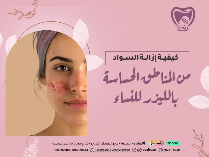 كيفية إزالة السواد من المناطق الحساسة بالليزر للنساء