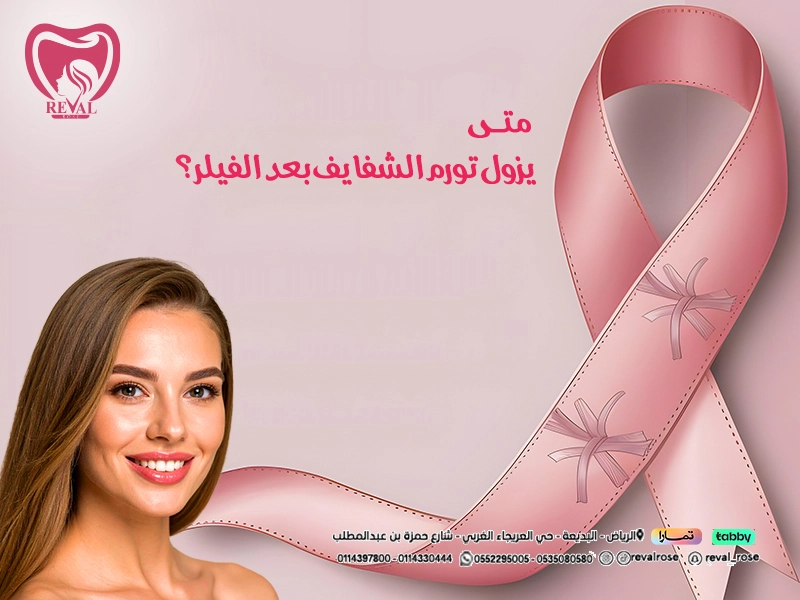 متى يزول تورم الشفايف بعد الفيلر؟ تعليمات بعد حقن فيلر شفايف