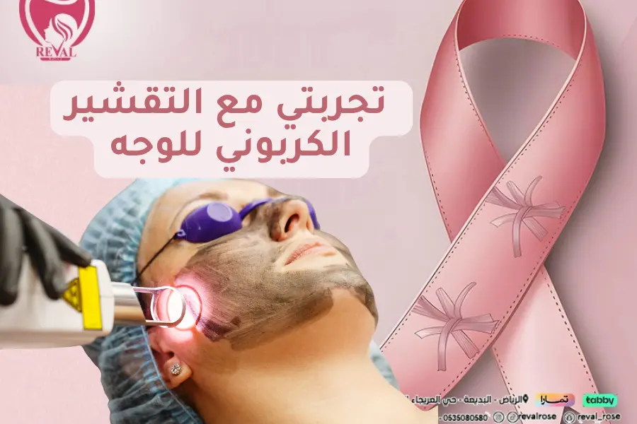 تجربتي مع التقشير الكربوني للوجه بالرياض
