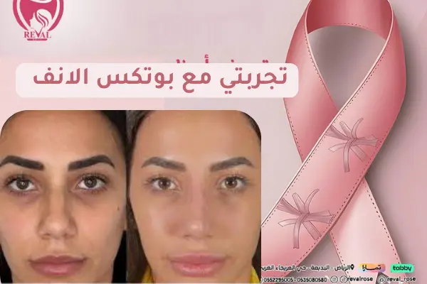 تجربتي مع بوتكس الأنف